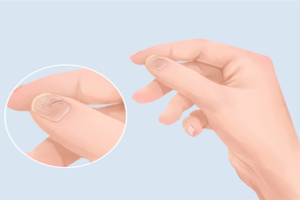 大拇指指甲凹陷是什么原因